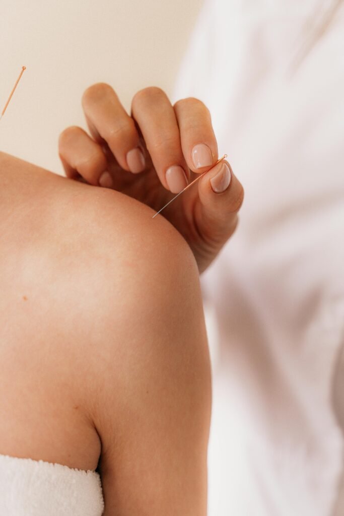 Person receiving acupuncture